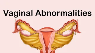 Vaginal Abnormalities | Gynecology | by Smit Chandegara