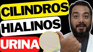 Cilindros hialinos na urina: o que pode ser? | Sedimentoscopia | EAS | Exame de urina tipo 1