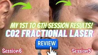 My 1st to 6th Session Results with Co2 Fractional Laser Treatment for my Acne Scars - Before After