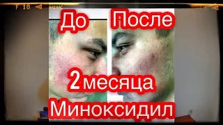 КАК ОТРАСТИТЬ БОРОДУ В 18 ЛЕТ(2 ЧАСТЬ ) .| MINOXIDIL I МОЯ ИСТОРИЯ | ЧТО ТАКОЕ БОРОДА ?