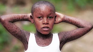 The Boy With Skin Like Snake Shocked Everyone : BORN DIFFERENT