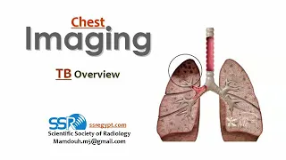 10 Chest TB - overview - prof.Mamdouh Mahfouz (2019 edition)