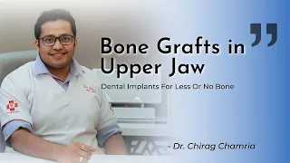 BONE GRAFTS in UPPER JAW | Dental Implants in Less or no Bone | Dr. Chirag Chamria