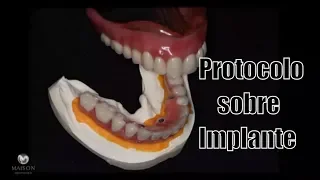 Prótese Fixa Sobre Implante debaixo (Dentadura Fixa)