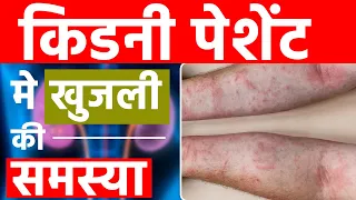 किडनी पेशेंट मे खुजली की समस्या | Symptoms of itching in kidney failure patients | DR Puru Dhawan