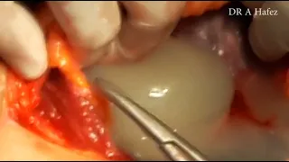 2nd Recurrent Caesarean Section Operation