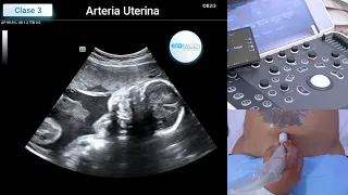 Clase 03: 01 Cómo medir la Arteria Uterina (1 y 2 para promedio) | Curso Ecografía Online