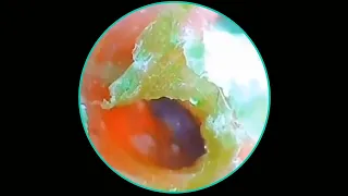 Satisfying Ear Wax Removal With Dr Zhao Video #113