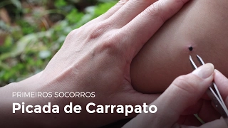 Picada de carrapato | Primeiros socorros