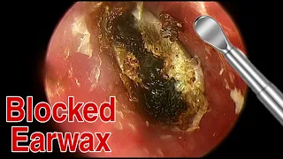 BIGGEST Ear Wax, Difficult Removal - EP5 | Doctor Anh