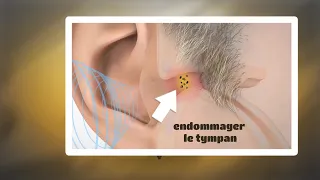 2mn pour comprendre le bouchon d'oreille