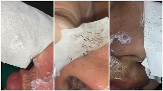 Extremely satisfying nose pore strips peel, for blackheads and pimples TikTok compilation : pt. 2 :