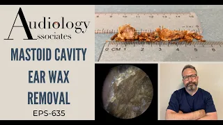 MASTOID CAVITY EAR WAX REMOVAL - EP635