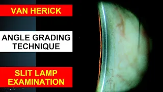 Van Herick Slit Lamp Technique | Angle Grading Technique | Anterior Chamber Angle Test