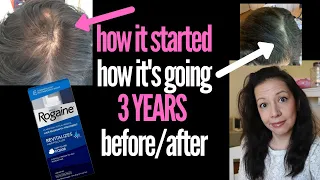 HONEST TALK ABOUT HOW ROGAINE IS WORKING FOR ME 3 YEARS LATER Women's Hair Loss Sufferer & NOT AN AD