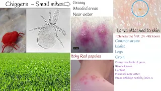 Chiggers bite - red bugs, harvest mites, symptoms and treatment.