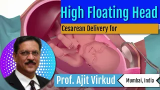 Cesarean delivery for floating head