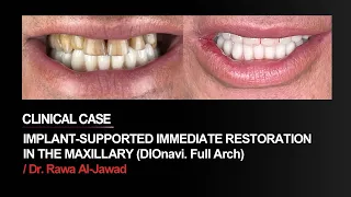 implant-supported immediate restoration with DIOnavi. FullArch