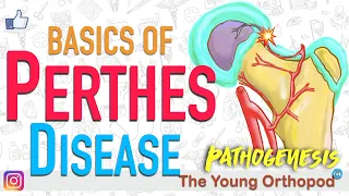 Perthes Disease, Avascular Necrosis, Pathogenesis, X Ray features, AIIMS, NEET PG, USMLE, Hip Pain