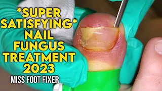 *Super Satisfying* Treating a Nail fungus [2023] By Podiatrist Miss Foot Fixer