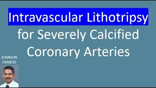 Intravascular Lithotripsy for Severely Calcified Coronary Arteries