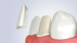 Cementazione  faccetta dentale in disilicato di litio step by step