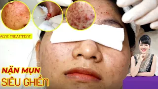 Điều trị mụn bọc, mụn viêm hiệu quả tại TPHCM | Hiền Vân Spa | Cyst Acne Treatment | 700