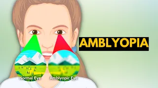 Amblyopia, Causes, Signs and Symptoms, Diagnosis and Treatment.