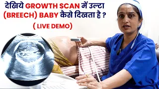 देखीये Growth Scan में उल्टा (breech) BABY कैसे दिखता है ?