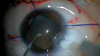 Cataract surgery and anterior vitrectomy in pediatric uveitis