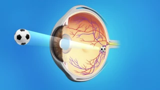 Cataract Surgery with a Monofocal Lens