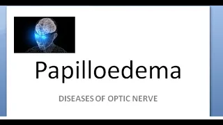 Ophthalmology Papilledema amaurosis fugax sometimes loss of vision cant see Hayreh theory