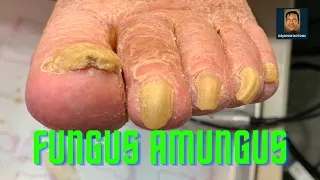 Another Fungal Toenail Video