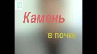 Камень в почке – что делать? Вырезать, дробить или подождать? Советы доктора Мясникова