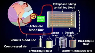 How a Dialysis Machine Works? | Dialysis | ARTIFICIAL KIDNEYS