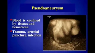 Pseudoaneurysms: Diagnosis and Treatment