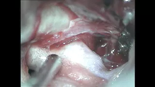 Intraoperative rupture of posterior communicating artery aneurysm