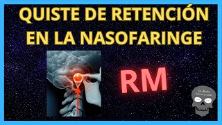 QUISTE DE RETENCIÓN del espacio MUCOSO FARÍNGEO 👉 Resonancia Magnética