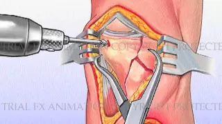 Tibial Plateau Fracture with Metal Plate Fixation