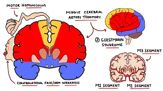 Middle Cerebral Artery Stroke Syndromes | MCA Stroke Syndromes (With Gerstmann Syndrome & Lesions!)