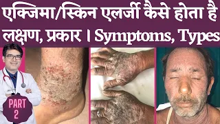 एक्ज़ेमा Symptoms In Hindi | Eczema Types with Pictures | लक्षण और प्रकार | Dermatologist | Jaipur