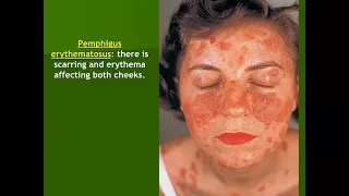 Lecture-77: Dermatopathology;  Vesicobullous dermatoses