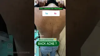 Back acne Treatment in Punjab #Dermatologistinchandigarh #Drashimagoel #acnetreatmentinchandigarh