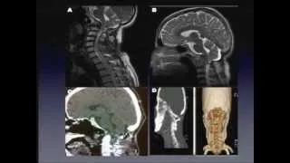 Tumors of the Craniovertebral Junction