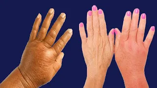 Swollen Hands: Causes And Home Remedies