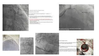 Interesting coronary angiograms