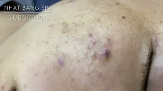 Satisfying and relaxing blackheads, pimple pop - Nhat Bang Acne Treatment- Chuyen Nguyen Spa #30