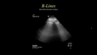 The BLUE Protocol Bedside Lung Ultrasound in Emergency