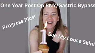 The Good, The Bad and The Saggy - One Year Post Op Gastric Bypass RNY Bariatric Surgery Surgiversary