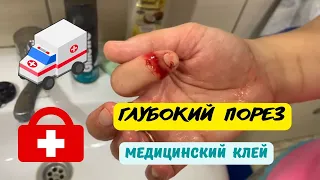 Глубокий порез ** ЧТО ДЕЛАТЬ? **